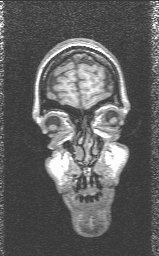 [Front view of human MRI slice]