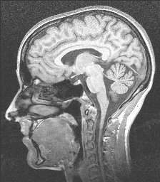 [Side view of human MRI slice]