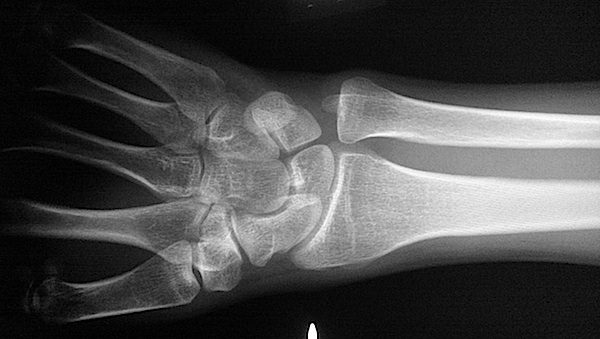 [X-ray of wrist]